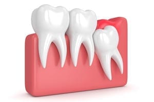 Tooth Extractions - Niagara Falls Dental Clinic