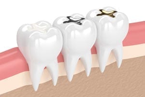 Tooth Coloured Fillings & Crown Niagara Falls