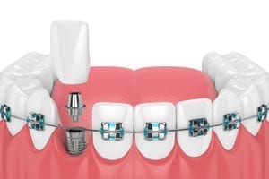 Orthodontic treatment with braces and tooth implants - illustrations 