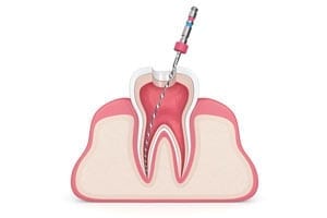 Root Canal Treatment illustration -best dentists in Niagara falls
