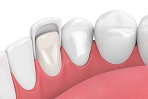 Veneers illustration 