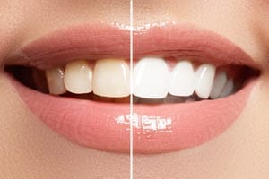 Teeth whitening white teeth before & after 