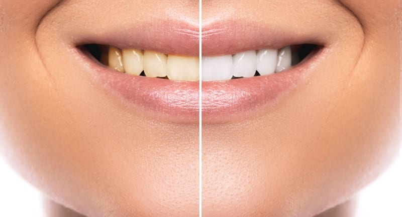 Before and after a teeth whitening procedure