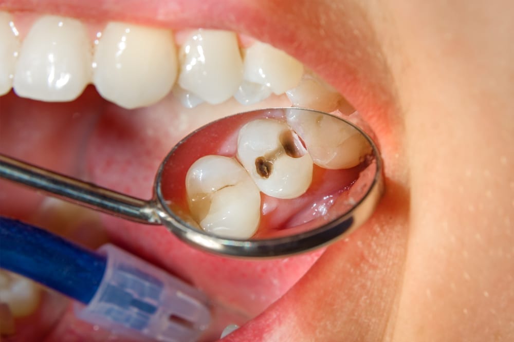 Image of Dentist checking cavities